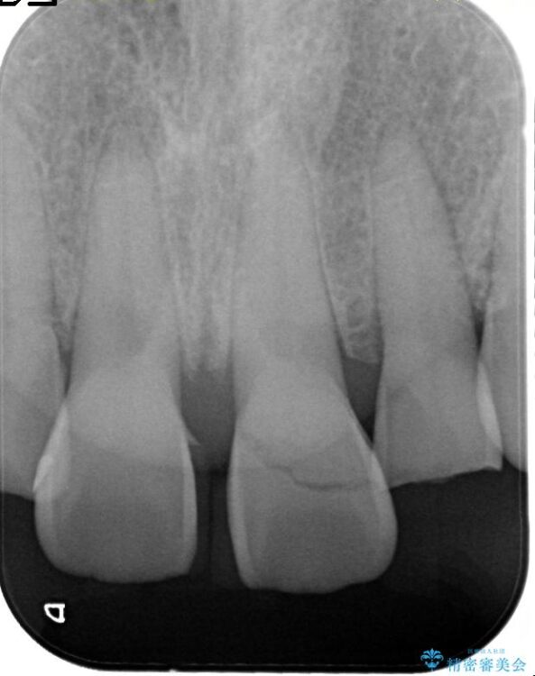 折れた前歯を抜歯せずに残す治療 治療前画像