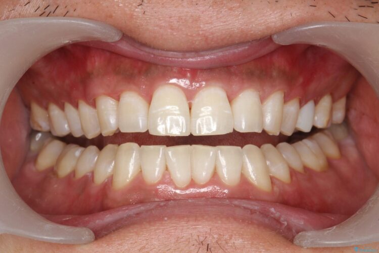 [オフィスホワイトニング] 奥歯のセラミックと色を合わせたい 治療後画像