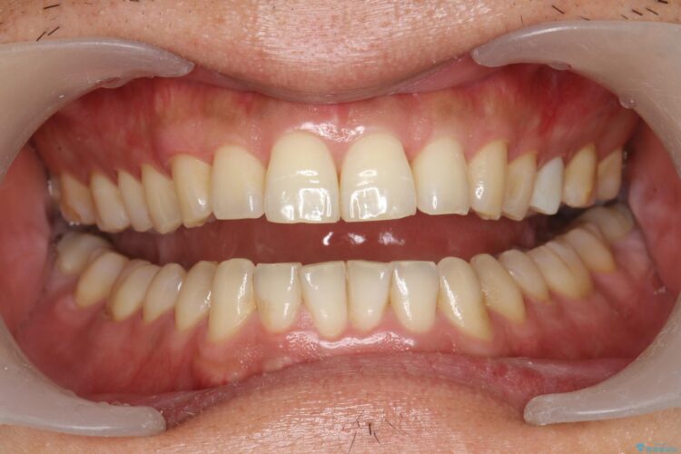 [オフィスホワイトニング] 奥歯のセラミックと色を合わせたい 治療前画像
