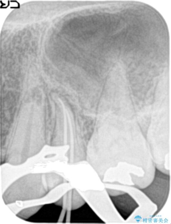 神経の壊死と根尖性歯周炎によって歯ぐきから膿が出ている状態の根管治療 治療途中画像