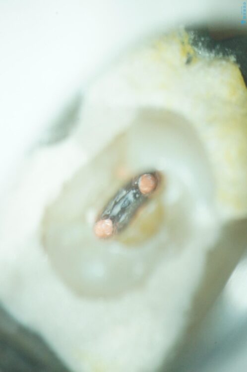 神経の壊死と根尖性歯周炎によって歯ぐきから膿が出ている状態の根管治療 治療途中画像