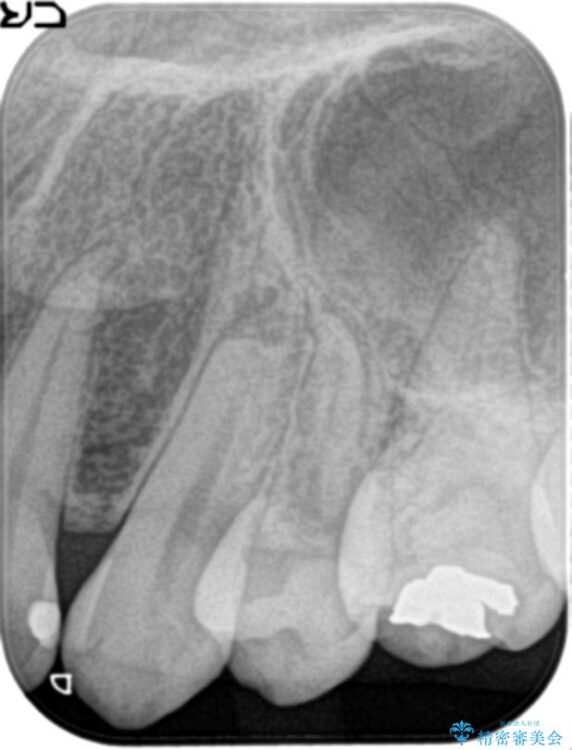 神経の壊死と根尖性歯周炎によって歯ぐきから膿が出ている状態の根管治療 治療前画像