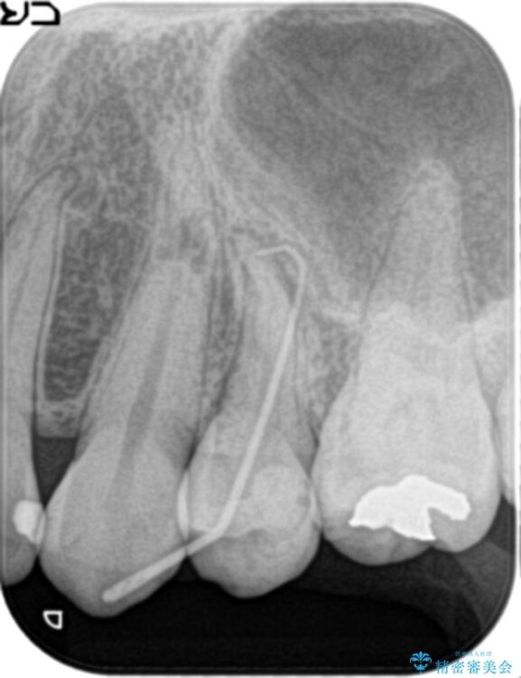 神経の壊死と根尖性歯周炎によって歯ぐきから膿が出ている状態の根管治療 治療前画像