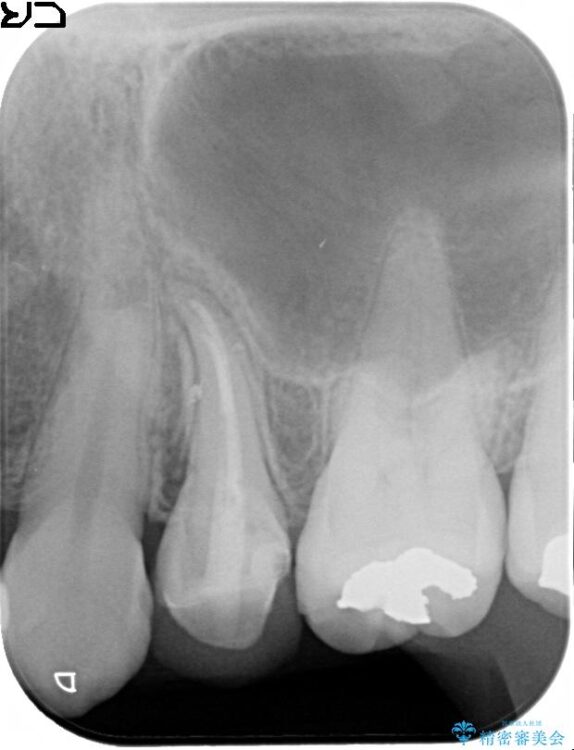 神経の壊死と根尖性歯周炎によって歯ぐきから膿が出ている状態の根管治療 アフター
