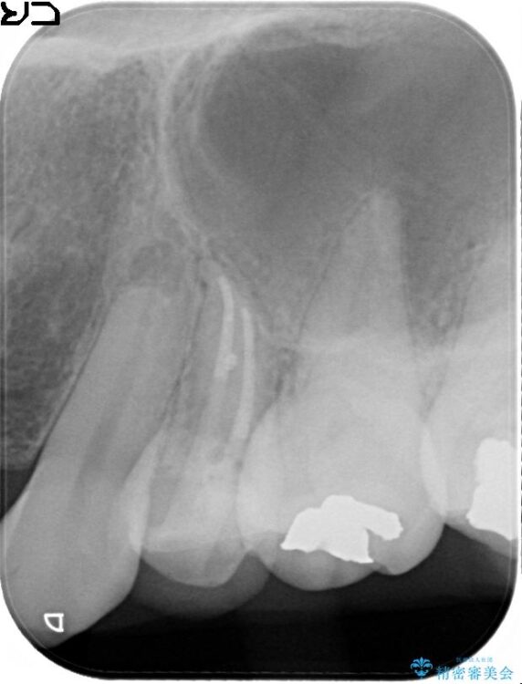 神経の壊死と根尖性歯周炎によって歯ぐきから膿が出ている状態の根管治療 治療後画像