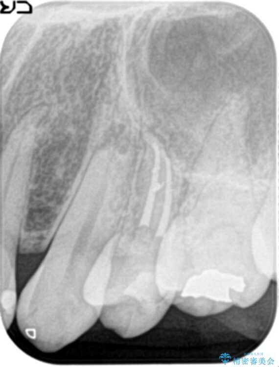 神経の壊死と根尖性歯周炎によって歯ぐきから膿が出ている状態の根管治療 治療後画像