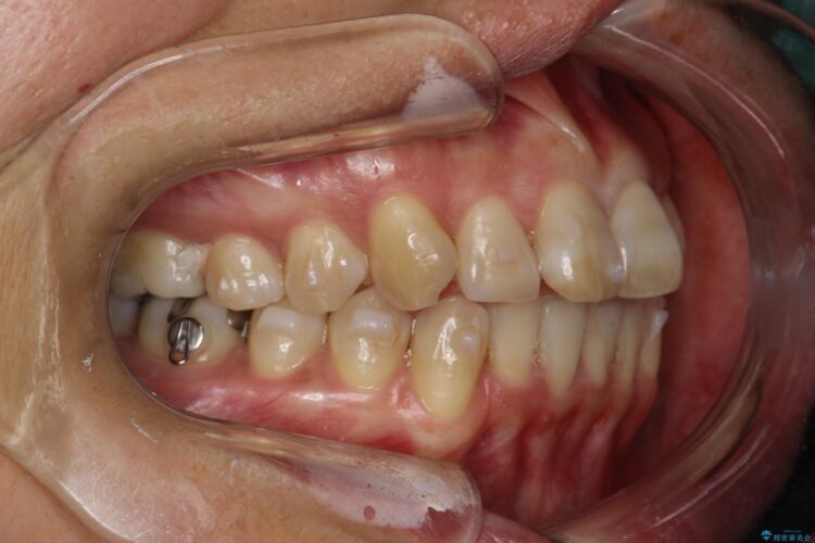 インビザラインで前歯の突出と上下歯並びのデコボコを改善 治療途中画像