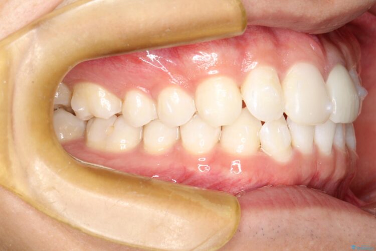 インビザラインで下の前歯の歯並びを改善 治療途中画像