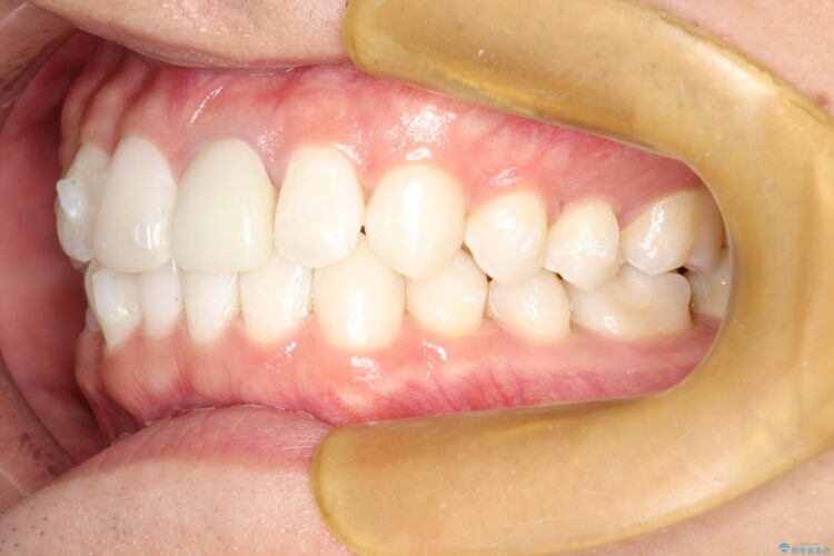 インビザラインで下の前歯の歯並びを改善 治療途中画像