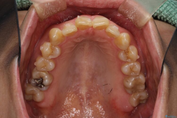 インビザラインで前歯の突出と上下歯並びのデコボコを改善 治療途中画像
