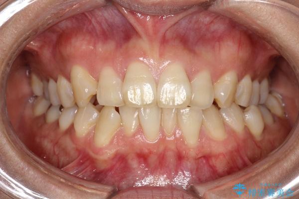 インビザラインで前歯の突出と上下歯並びのデコボコを改善 治療前