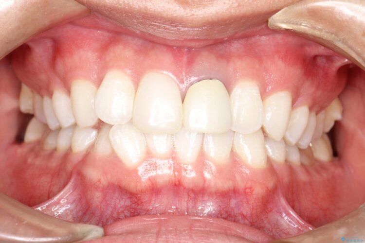 インビザラインで下の前歯の歯並びを改善 治療前画像
