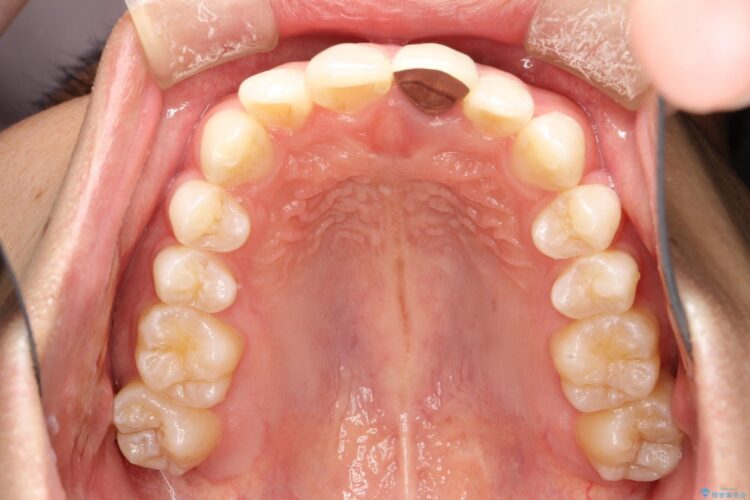 インビザラインで下の前歯の歯並びを改善 治療前画像