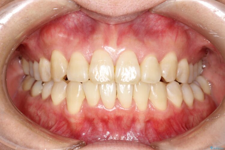 インビザラインで前歯の突出と上下歯並びのデコボコを改善 アフター
