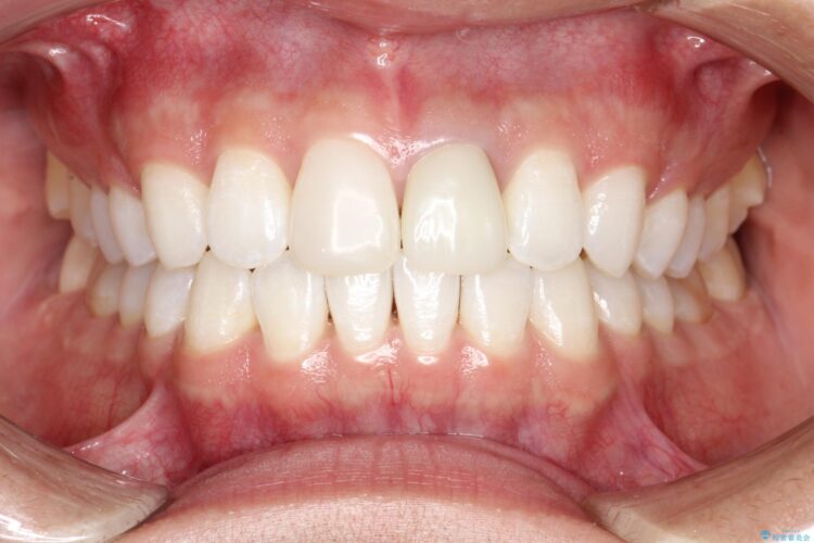 インビザラインで下の前歯の歯並びを改善 アフター