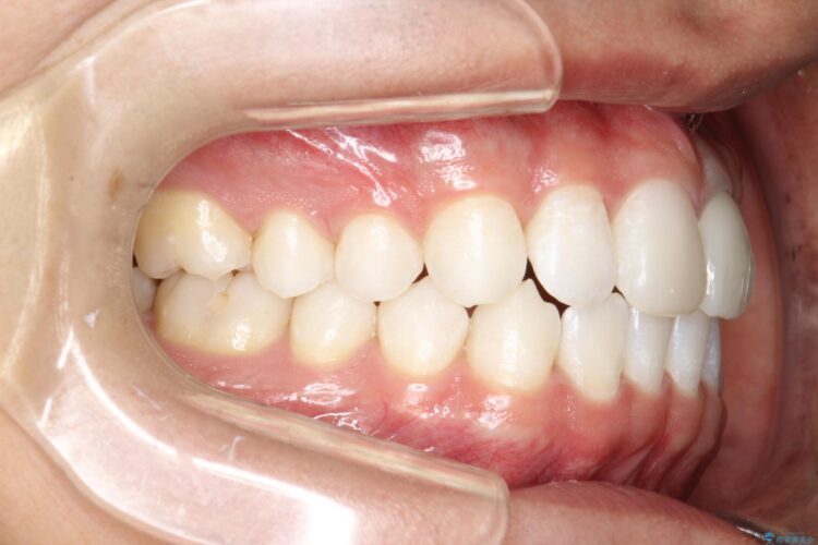 インビザラインで下の前歯の歯並びを改善 治療後画像
