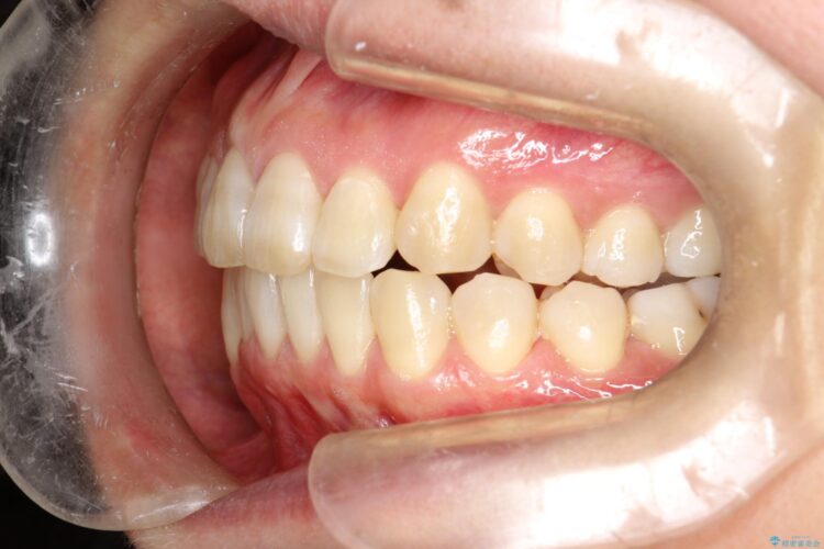 インビザラインで前歯の突出と上下歯並びのデコボコを改善 治療後画像