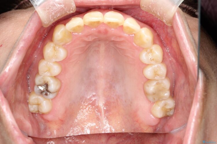 インビザラインで前歯の突出と上下歯並びのデコボコを改善 治療後画像