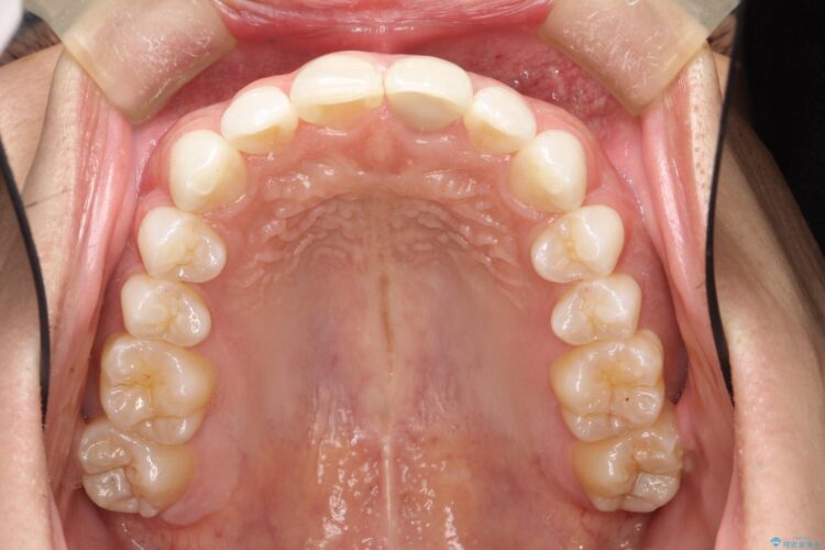 インビザラインで下の前歯の歯並びを改善 治療後画像
