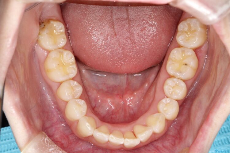 インビザライン ライトパッケージで部分矯正　下の前歯のみの歯並び改善 治療途中画像
