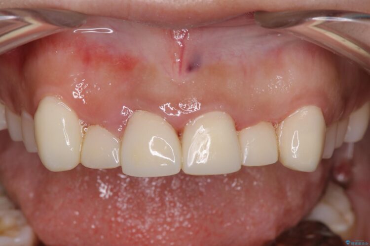セラミック矯正で前歯をきれいに 治療途中画像