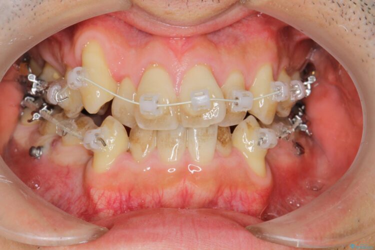 前歯のガタガタと八重歯 骨格性下顎前突のカモフラージュ矯正 治療途中画像