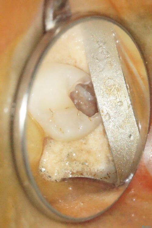 虫歯が深くなった状態で神経を残す生活歯髄療法 治療途中画像