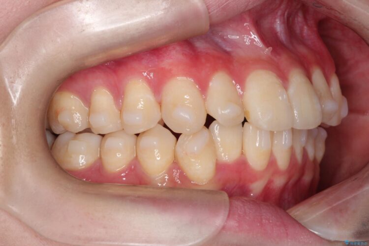 インビザラインで前歯の捻れとガタつきの改善(非抜歯) 治療途中画像