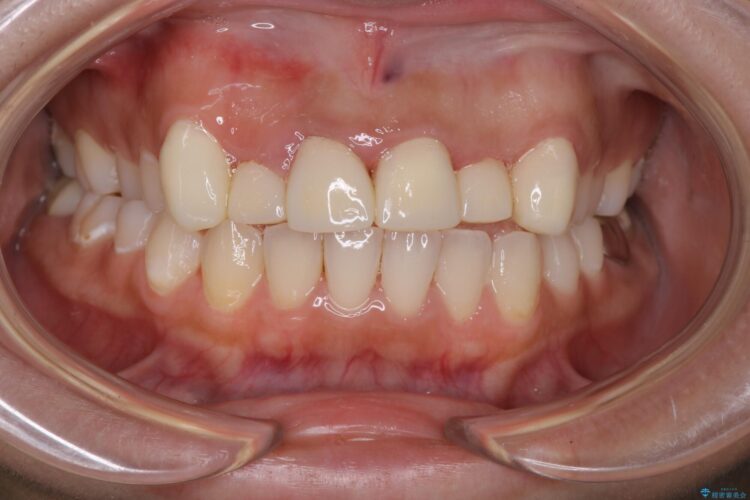 セラミック矯正で前歯をきれいに 治療途中画像