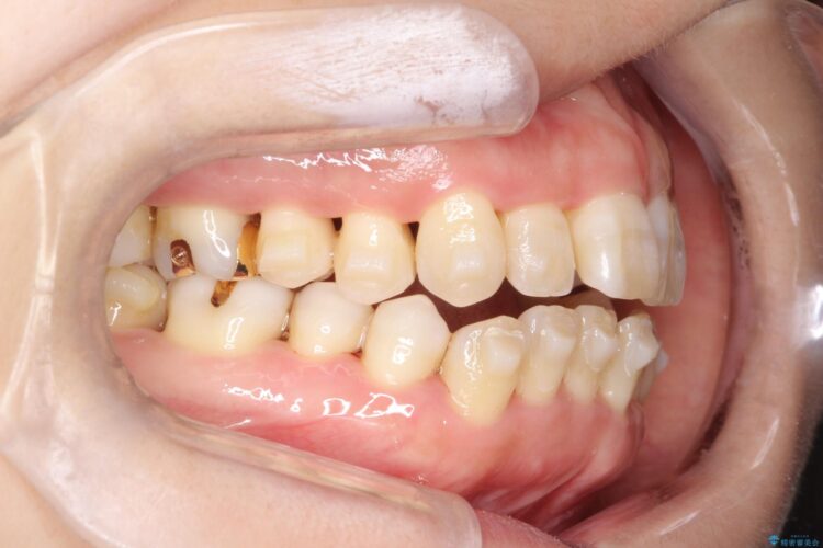 インビザラインで上下前歯の開き(開咬)と上下ガタつき(叢生)の改善 治療途中画像