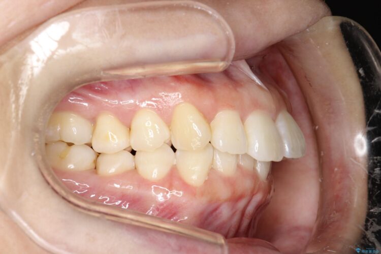 インビザライン ライトパッケージで部分矯正　下の前歯のみの歯並び改善 治療途中画像