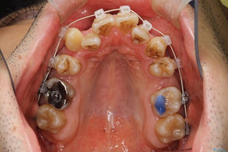 前歯のガタガタと八重歯 骨格性下顎前突のカモフラージュ矯正 治療途中画像