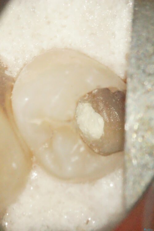 虫歯が深くなった状態で神経を残す生活歯髄療法 治療途中画像