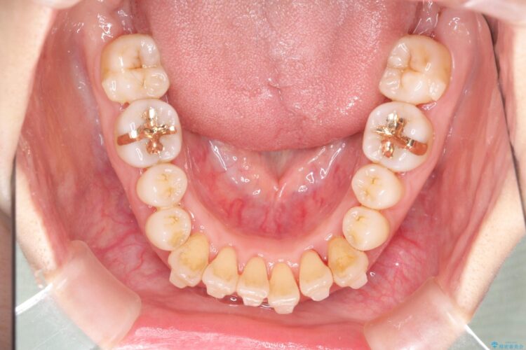 インビザラインで上下前歯の開き(開咬)と上下ガタつき(叢生)の改善 治療途中画像