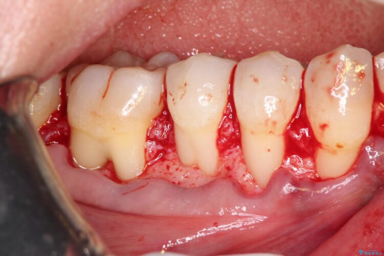 下がってしまった歯肉　バイオマテリアルを応用した歯茎の回復 治療途中画像