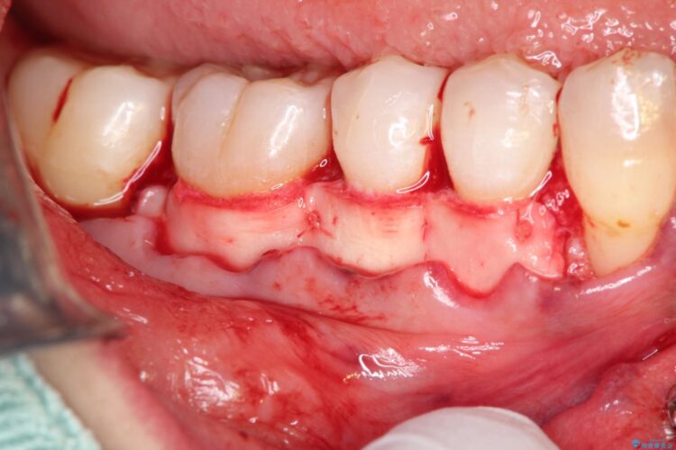 下がってしまった歯肉　バイオマテリアルを応用した歯茎の回復 治療途中画像