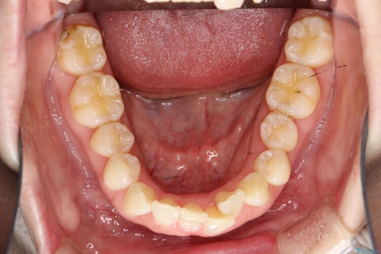 インビザライン ライトパッケージで部分矯正　下の前歯のみの歯並び改善 ビフォー