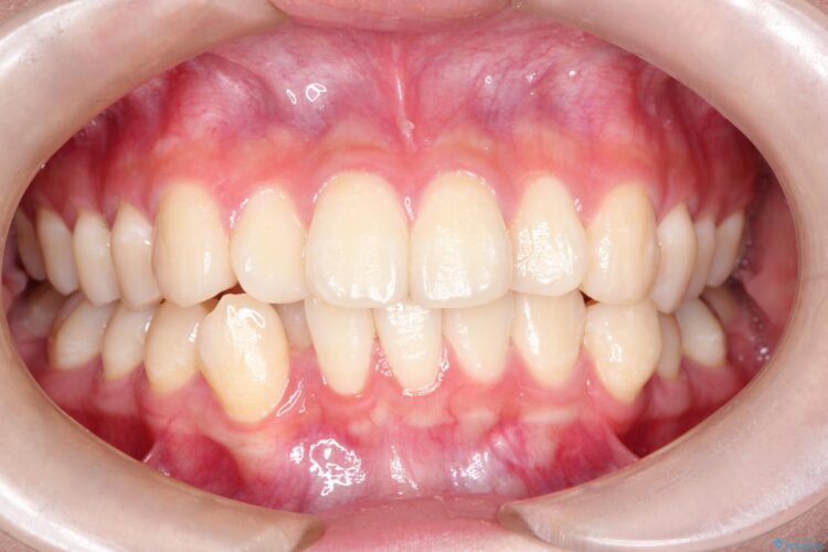 インビザラインで前歯の捻れとガタつきの改善(非抜歯) ビフォー