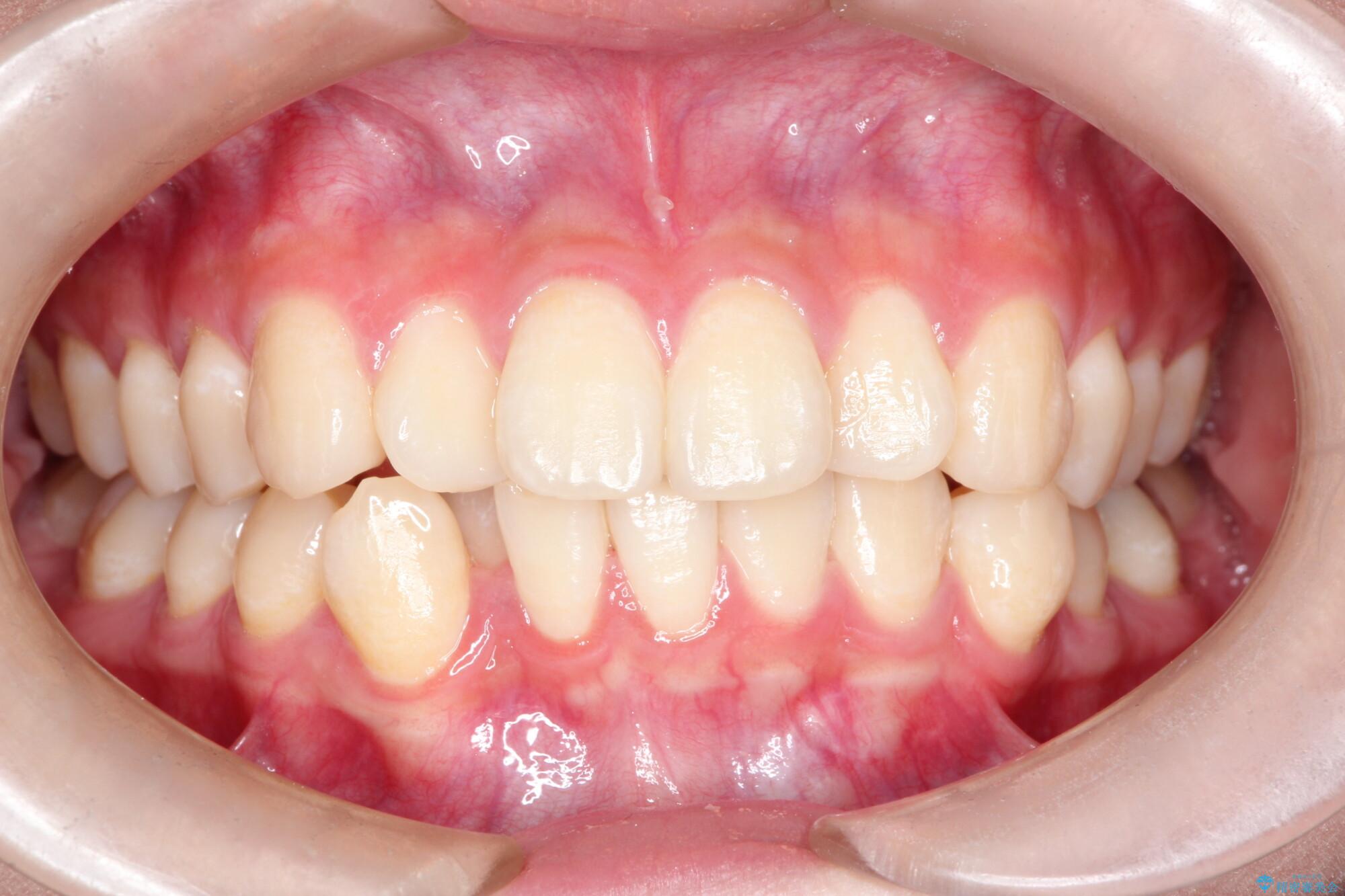 インビザラインで前歯の捻れとガタつきの改善(非抜歯) 治療前