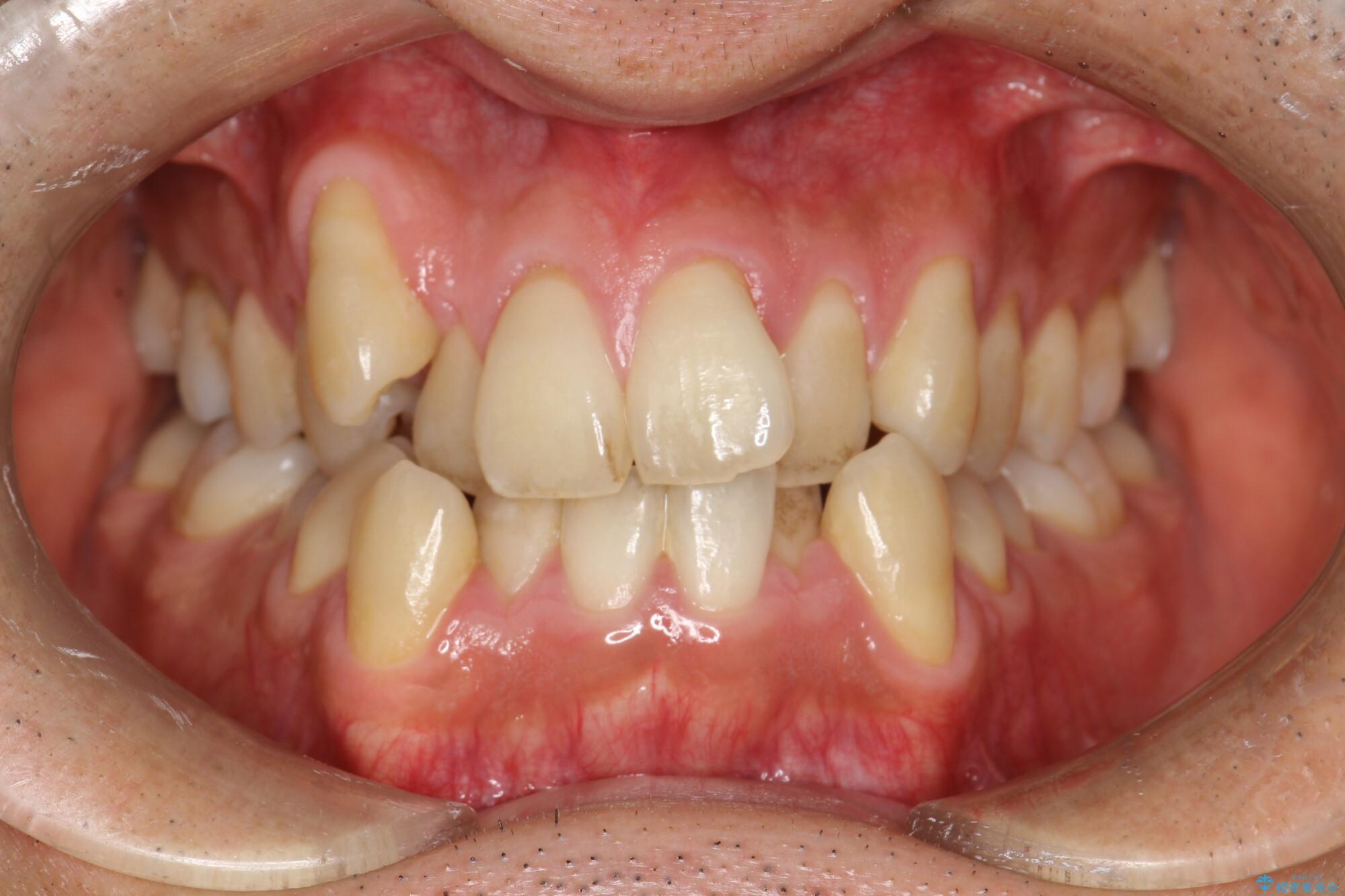 前歯のガタガタと八重歯 骨格性下顎前突のカモフラージュ矯正 治療前