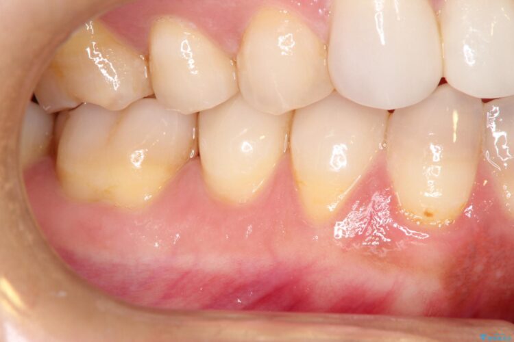 下がってしまった歯肉　バイオマテリアルを応用した歯茎の回復 ビフォー
