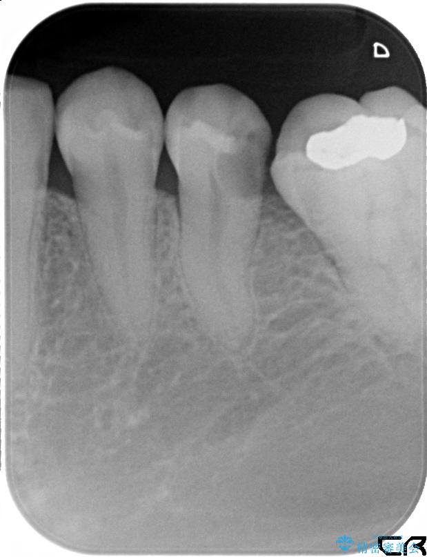 虫歯が深くなった状態で神経を残す生活歯髄療法 治療前