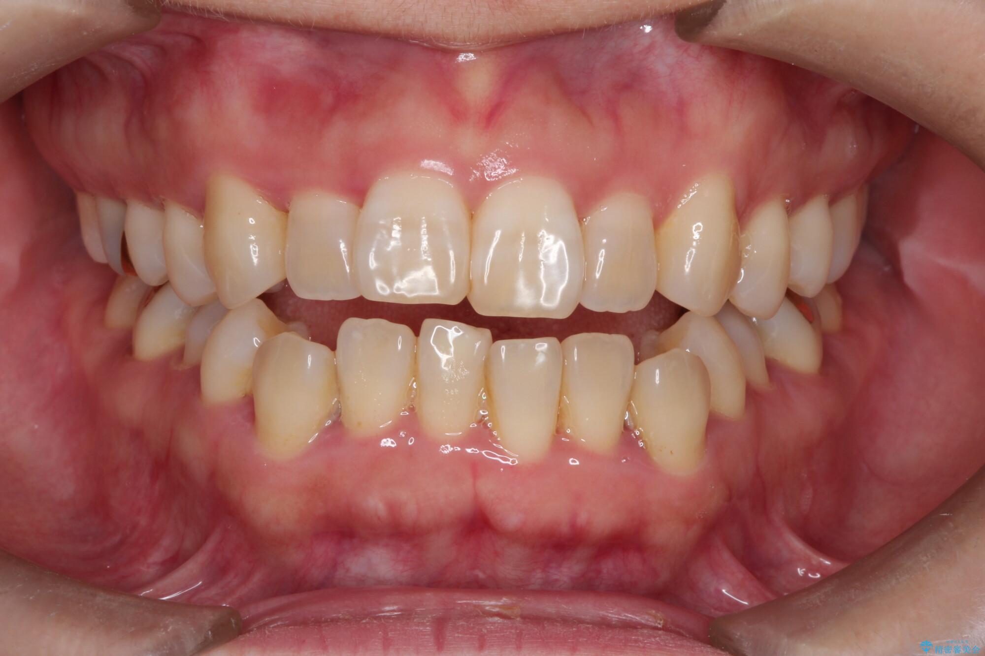 インビザラインで上下前歯の開き(開咬)と上下ガタつき(叢生)の改善 治療前