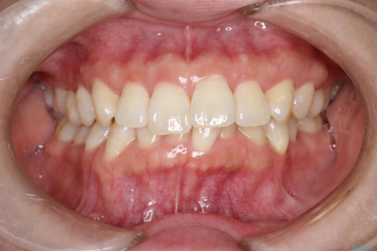 インビザライン ライトパッケージで部分矯正　下の前歯のみの歯並び改善 治療前画像