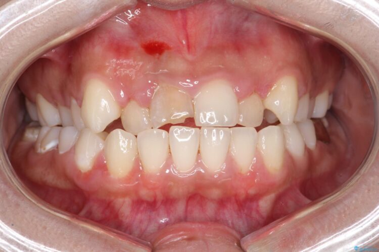 セラミック矯正で前歯をきれいに 治療前画像