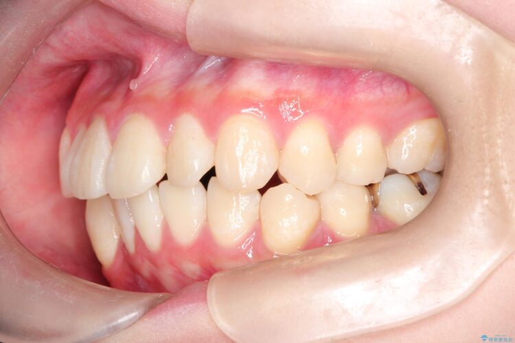 インビザラインで前歯の捻れとガタつきの改善(非抜歯) 治療前画像