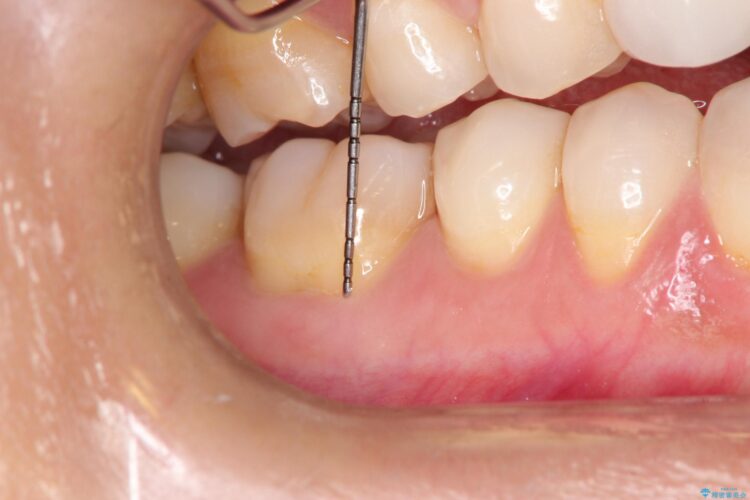 下がってしまった歯肉　バイオマテリアルを応用した歯茎の回復 治療前画像