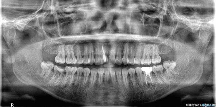 セラミック矯正で前歯をきれいに 治療前画像