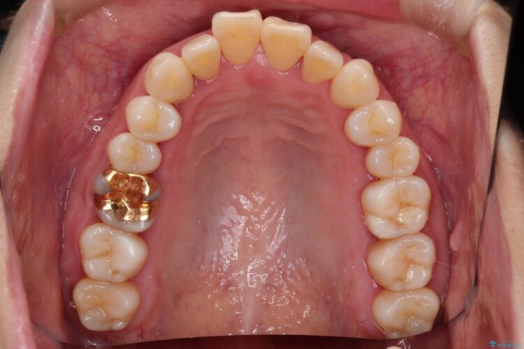 インビザラインで上下前歯の開き(開咬)と上下ガタつき(叢生)の改善 治療前画像