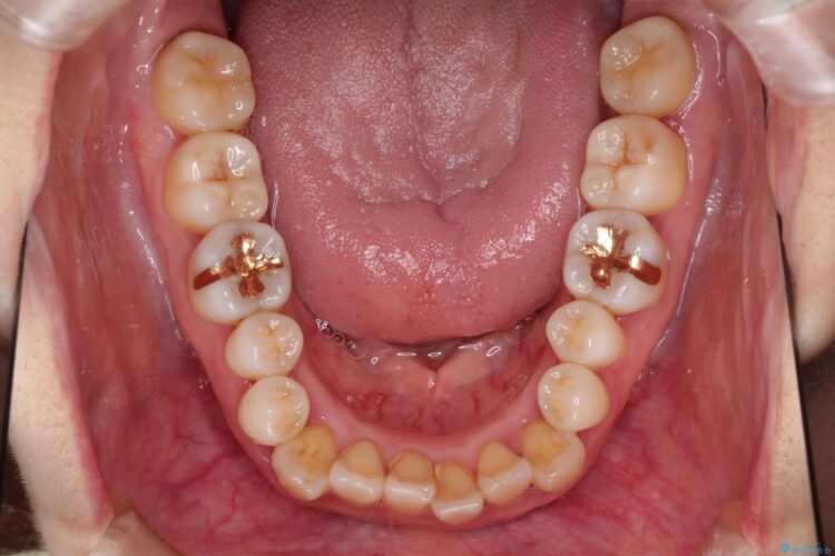 インビザラインで上下前歯の開き(開咬)と上下ガタつき(叢生)の改善 治療前画像
